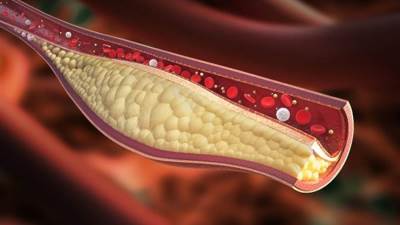 ما هي أعراض ارتفاع مستويات الكوليسترول فى الدم؟؟